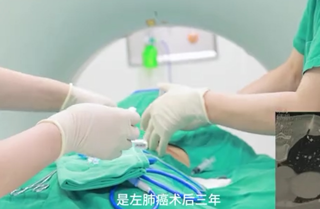 微波消融術后轉(zhuǎn)移結(jié)節(jié)